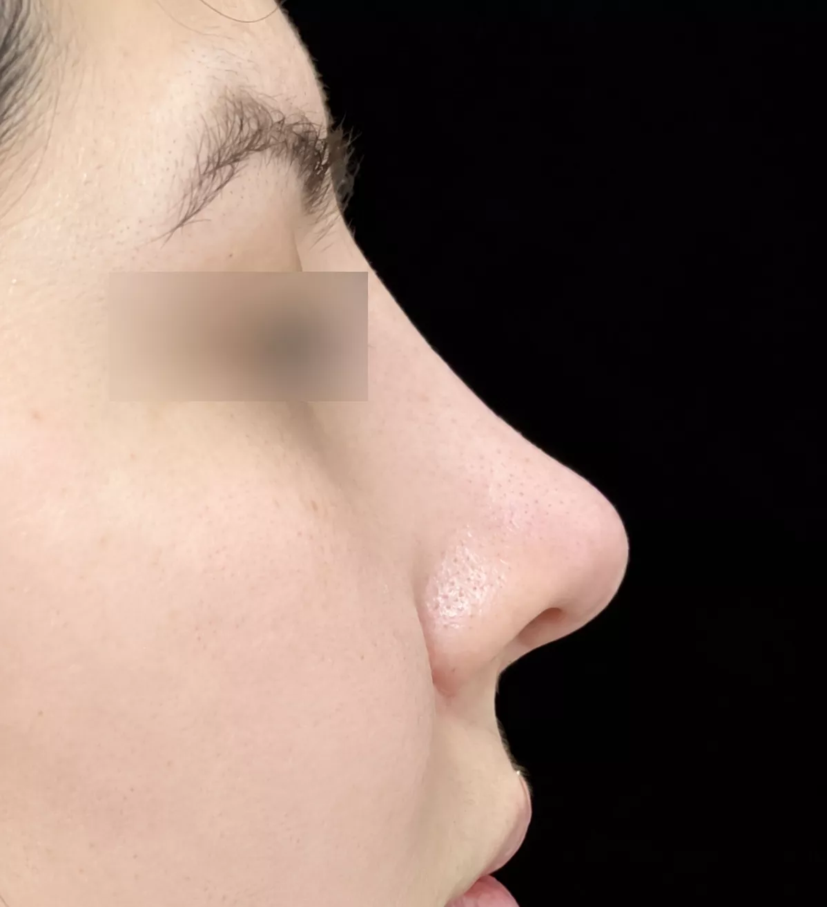 Fotografía de perfil nasal después de la rinoplastia, del mismo caso autorizado. Ojos cubiertos para proteger la identidad del paciente.