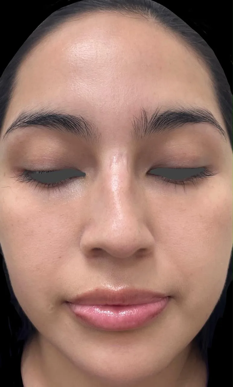 Fotografía frontal antes de la rinoplastia, de un caso autorizado por el paciente. Ojos cubiertos para proteger su identidad.