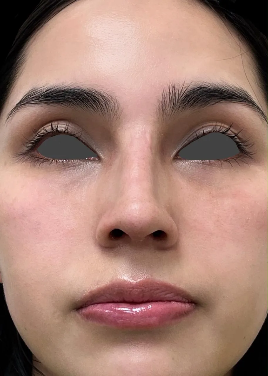 Fotografía frontal después de la rinoplastia, del mismo caso autorizado. Ojos cubiertos para proteger la identidad del paciente.